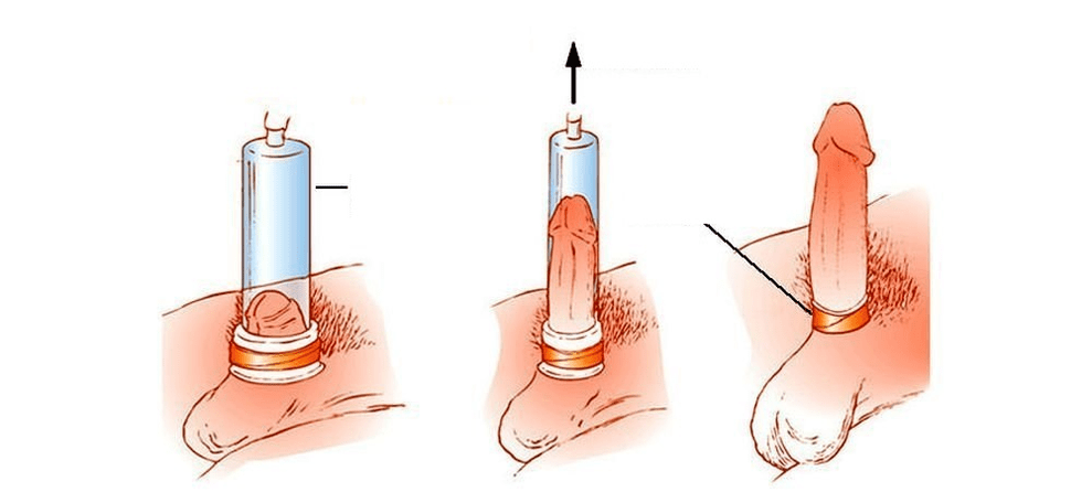 How a vacuum pump works for penis enlargement