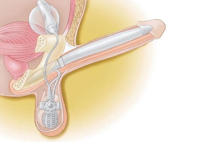 penis prostheses for enlargement