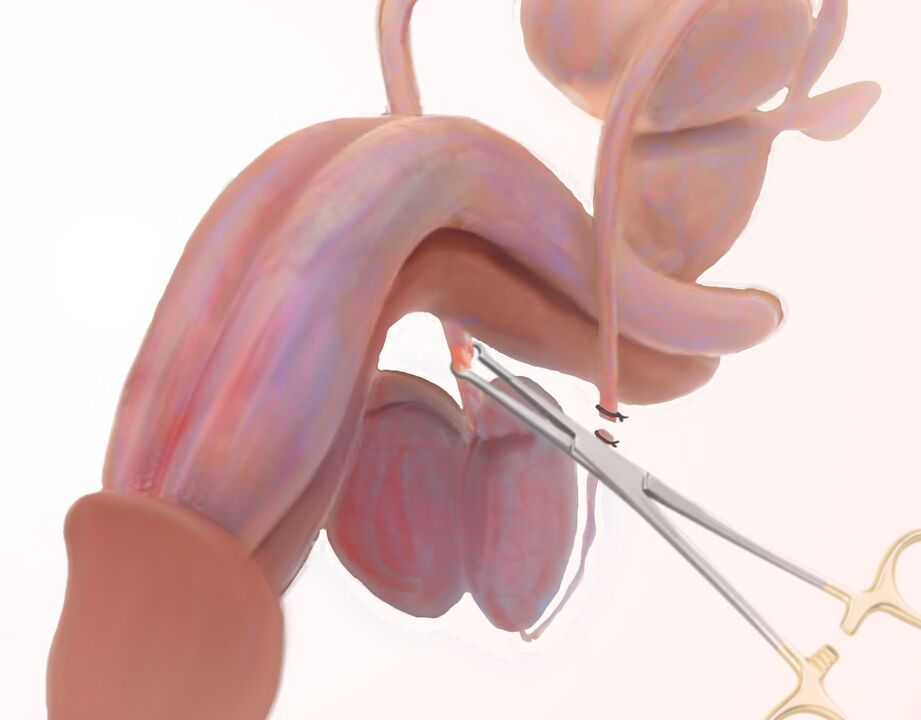 ligamentotomy for penis enlargement