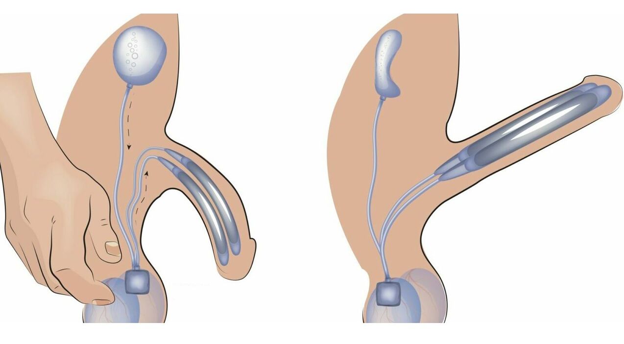 penile prosthesis for penis enlargement